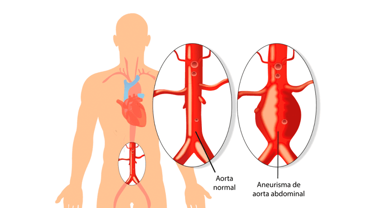 Aneurisma de la Aorta Abdominal