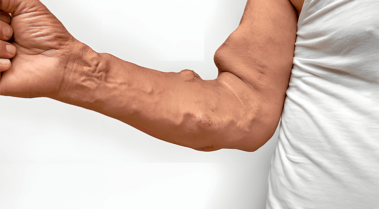 Fístulas Arteriovenosas Patológicas o Traumáticas