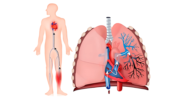 Tromboembolismo Pulmonar