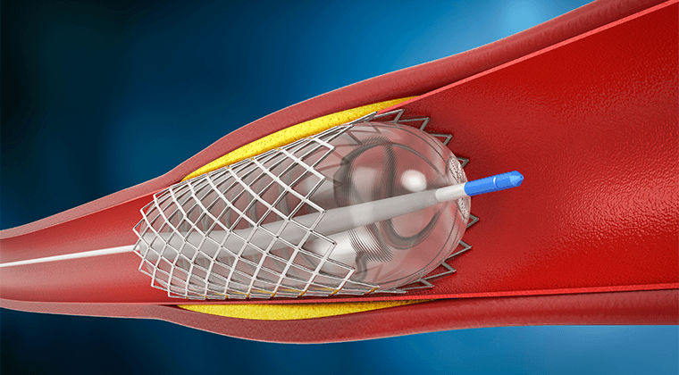 Angioplastia arterial