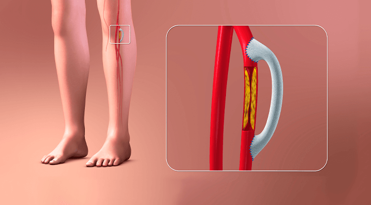Bypass arterial