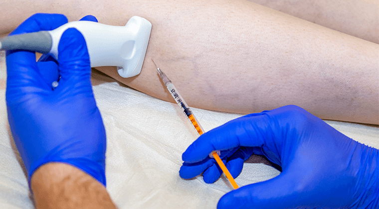 Escleroterapia