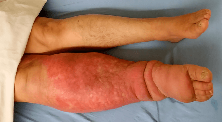 Edema unilateral